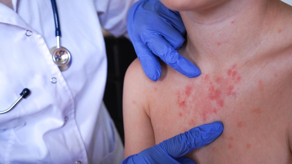 Minnesota's 80 measles cases this year are the most since 1990, health officials say — St. Paul Health news